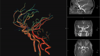 Vascular brain scan
